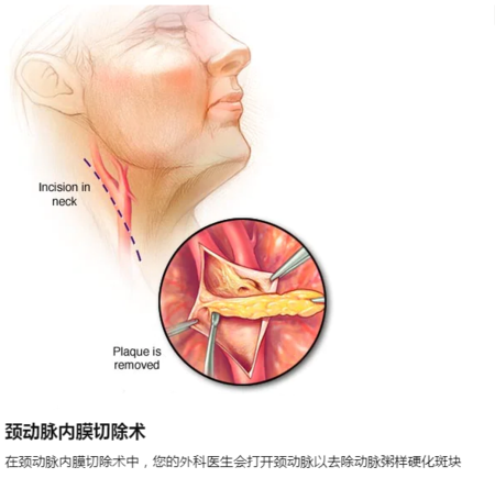 頸動脈內(nèi)膜剝脫術(shù).png