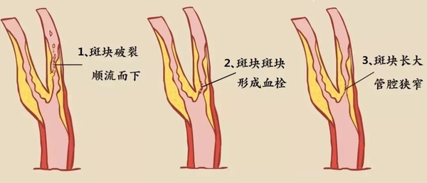 颈动脉斑块的主要危险